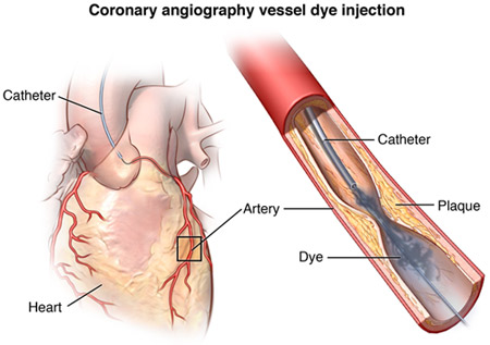 Coronary Angioplasty Specialist